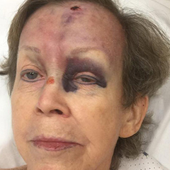 senior caucasian female with head injury and bruise around eye